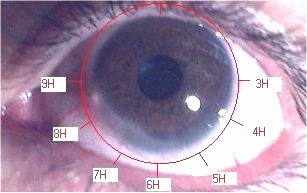iridologie, penis et circoncision