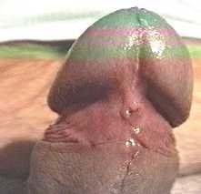 prpuce circoncis, frein coup